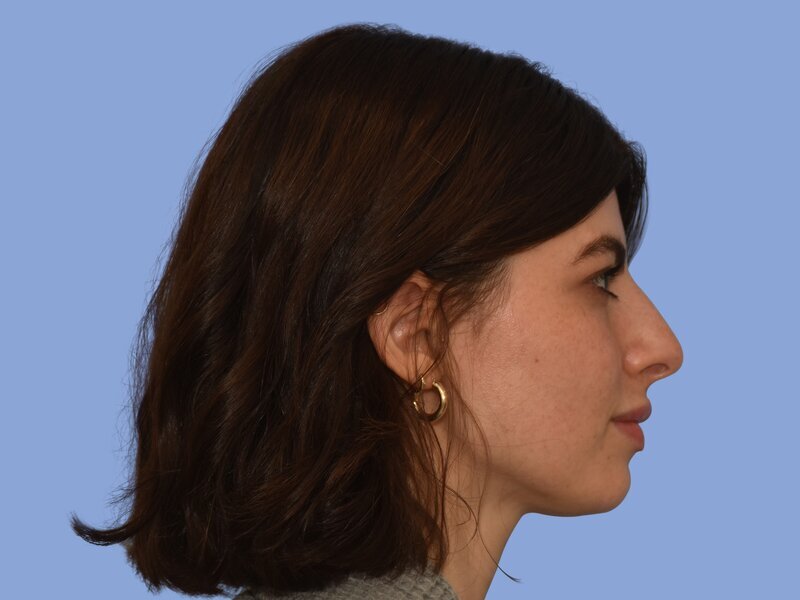 Rhinoplasty Before & After